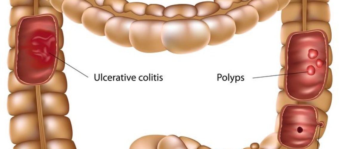 diverticulose