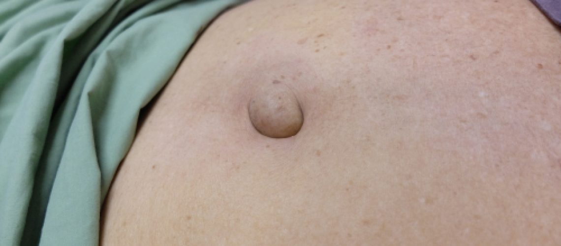 hérnia umbilical