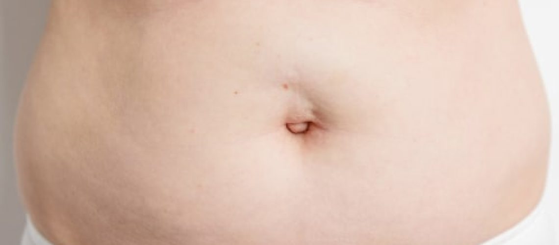 Hérnia umbilical