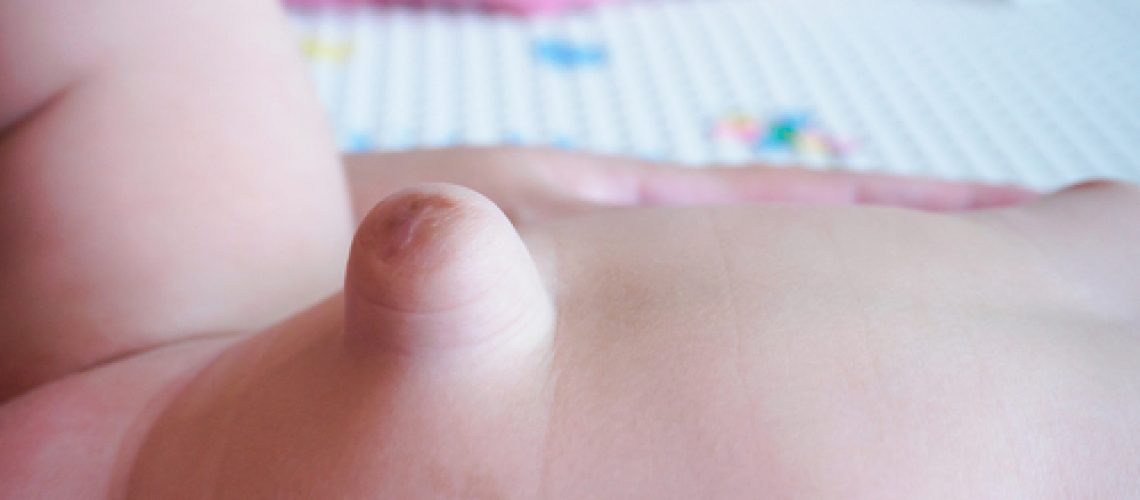 hérnia umbilical